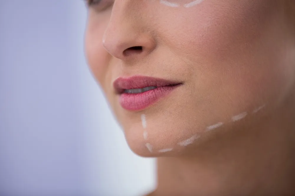 pointy chin dermal filler correction explained